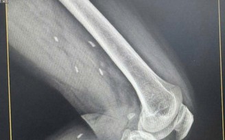 Kén sán rải rác trong vùng đùi và cẳng chân bệnh nhân