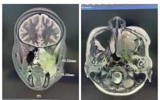 Đau hàm, nghẹt mũi, chảy máu răng - Đi khám phát hiện ung thư xoang