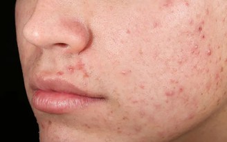 Da sau mụn nhạy cảm kéo dài: Khi hàng rào da chưa thực sự hồi phục