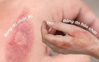 Cứ nghĩ sẹo bỏng phải xâm lấn nhưng dùng kem mờ sẹo vẫn hiệu quả nhanh chóng