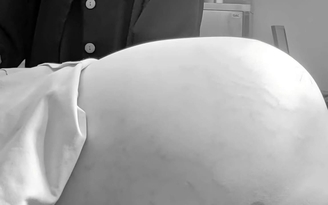 Bệnh viện Nhi đồng 1 TP.HCM mổ bướu buồng trứng 15 kg ở bé gái 14 tuổi