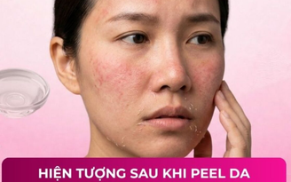 Cần làm gì sau khi peel da? Bất ngờ 99% đều làm sai khiến da tổn thương Cần làm gì sau khi peel da? Bất ngờ 99% đều làm sai khiến da tổn thương