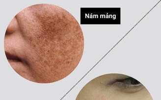 +3 kem mờ nám chân sâu sau khoảng 4 tuần khiến chị em không tin vào mắt