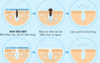 Da mụn nên dùng BHA hay AHA - phương pháp chăm da mụn chuẩn khoa học