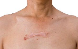 30 - 50% nguy cơ sẹo lồi xuất phát từ một yếu tố ít được nhắc đến