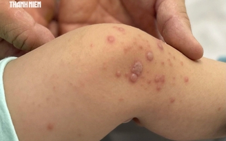 TP.HCM: Bệnh tay chân miệng tăng mạnh, hơn 8.150 ca mắc, 3 ca tử vong