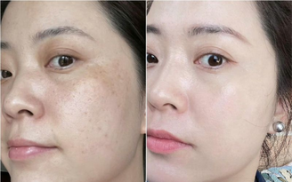 Top 5 kem giảm nám, đốm nâu hiệu quả sau 4 tuần, mờ cả nám lâu năm