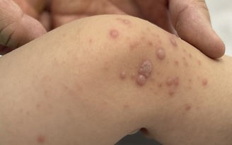 Việt Nam chờ vắc xin tay chân miệng nhập về hạ nhiệt dịch