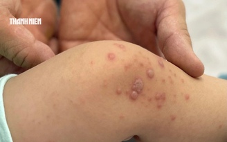 Bệnh tay chân miệng tăng cao: Vắc xin vẫn chờ công bố  giá