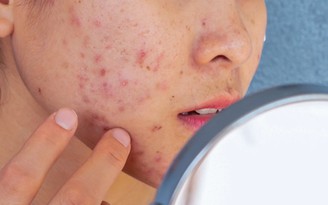 Nắng nóng đỉnh điểm kéo dài: Da dầu mụn vì sao càng skincare mụn càng bùng phát?