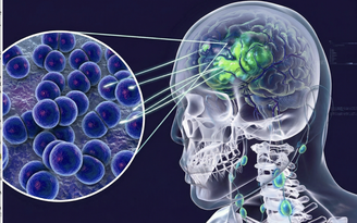 Cà Mau: 3 ca nghi viêm não mô cầu, 2 ca dương tính, 1 ca tử vong