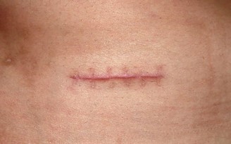 Định nghĩa lại phục hồi hậu phẫu: Từ ‘liền thương’ đến ‘liền thương có kiểm soát’