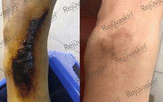 Sẹo phì đại ở khớp: nguyên nhân, nguy cơ và hướng điều trị sớm