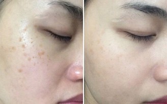 Top 5 serum mờ nám, thậm chí nám hỗn hợp tưởng chừng chưa tồn tại