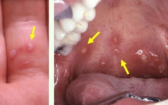 TP.HCM: Biến thể mới gây tay chân miệng nguy hiểm thế nào?