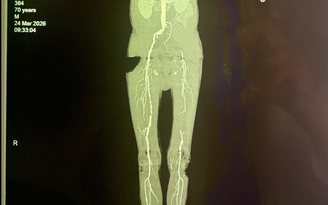 Loét gót chân kéo dài, bệnh nhân suýt phải cưa chân