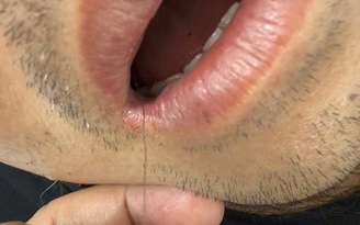 Hy hữu: Dây cước lộ ngoài miệng, bác sĩ nội soi gắp lưỡi câu khỏi thực quản