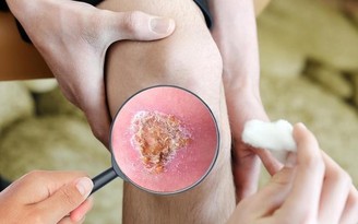 Giải mã ‘cuộc chiến’ vi mô tại vết thương: Khi sự kiểm soát quyết định phục hồi