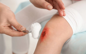 Cách dùng kem bôi vết thương hở tưởng đơn giản nhưng nhiều người vẫn làm sai