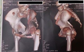 TP.HCM: Giải mã gien phát hiện bé gái mắc hội chứng người hóa đá cực hiếm gặp