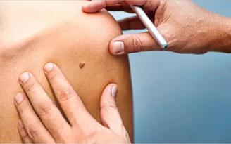 Công bố nghiên cứu mới về nốt ruồi và nguy cơ ung thư hắc tố da