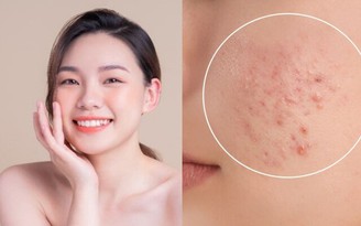Hết tình trạng bí da mùa hè: Sản phẩm phục hồi này đang gây sốt khắp TikTok