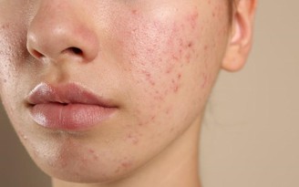 Kháng kháng sinh trong điều trị mụn và giải pháp thay thế từ tia Plasma lạnh