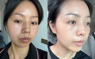 Top 6 serum giúp nám đậm màu cũng bật tone trắng hồng, kể cả nám chân sâu