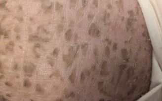 Bệnh hiếm gặp vảy cá bẩm sinh