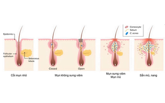 Gel chấm mụn nên dùng khi nào? Những lưu ý trước khi chấm mụn