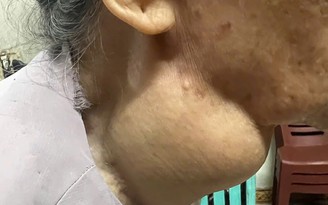 Vinmec Hạ Long loại bỏ khối u giáp khổng lồ 18 năm của cụ bà 88 tuổi