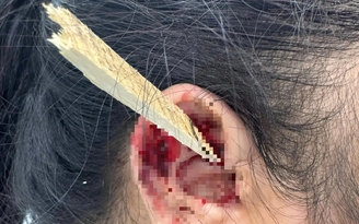 Mảnh gỗ dài 15 cm đâm xuyên tai nữ công nhân khi đang cưa gỗ