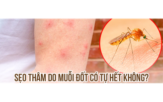 Bị sẹo thâm do muỗi đốt và côn trùng cắn có trị hết được không?