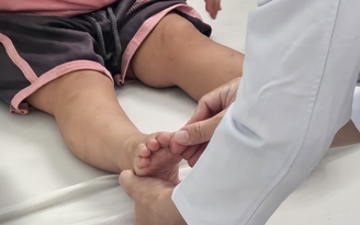 Gần 100.000 ca tay chân miệng: Cảnh giác virus EV71 gây biến chứng thần kinh