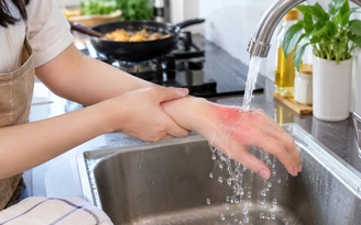 Bỏng tại nhà: 5 cách sơ cứu cần biết
