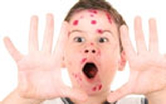 Một cách “phế võ công” virus thủy đậu