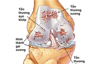 Đừng để thoái hóa khớp là gánh nặng