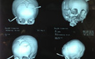 Cứu sống em bé bị thanh sắt đâm xuyên não