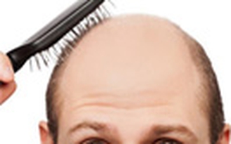 Hói đầu trước 40 tuổi tăng nguy cơ mắc ung thư tuyến tiền liệt