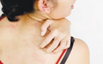 Viêm da tiếp xúc do côn trùng