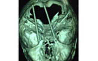 Phẫu thuật lấy đôi đũa đâm xuyên não bệnh nhân