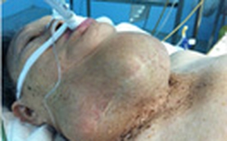Bướu cổ “cứng như đá”
