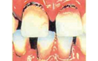 Mảng bám trên răng: Đừng coi thường