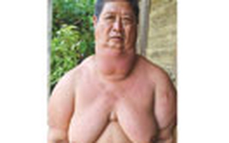 Người đàn ông có bộ ngực 'khủng'