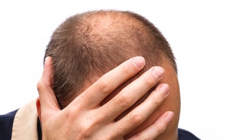 Đẩy lùi nỗi lo rụng tóc ở nam giới