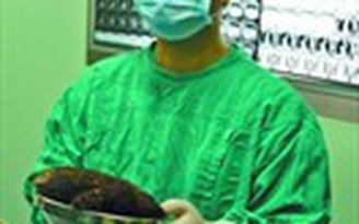 Nửa kg tóc trong dạ dày
