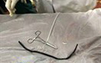 Lấy dây điện dài 40 cm nằm trong ruột người gần 2 năm