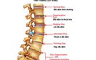 Thoái hóa cột sống - Làm thế nào để khỏi bệnh?