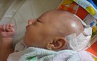 Mổ lấy thành công khối u thoát vị não cho bé 15 ngày tuổi