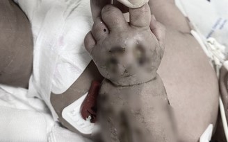 Bé sơ sinh nằm võng bị máy may đè dập nát tay